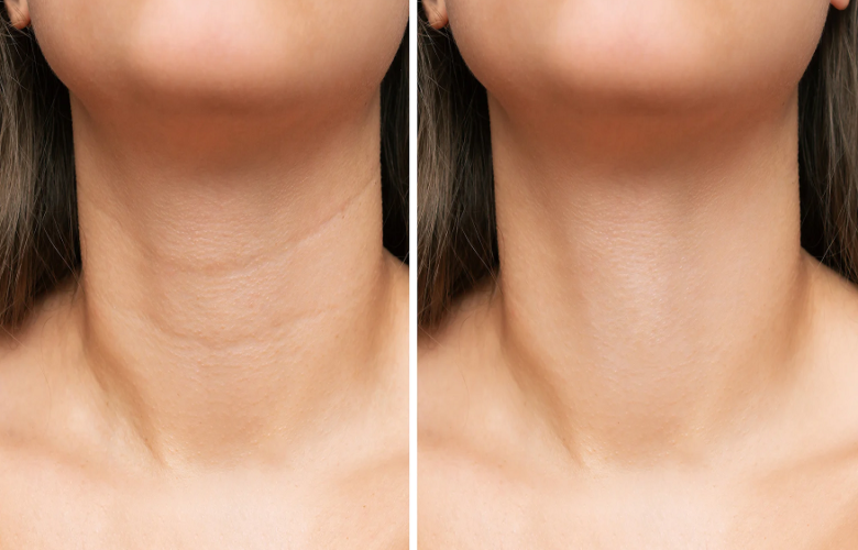 Brilliant Ways to Prevent Wrinkles on the Neck